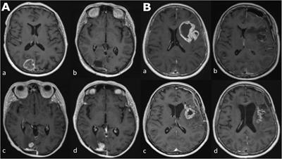 Imaging Biomarkers of Glioblastoma Treatment Response: A Systematic Review and Meta-Analysis of Recent Machine Learning Studies